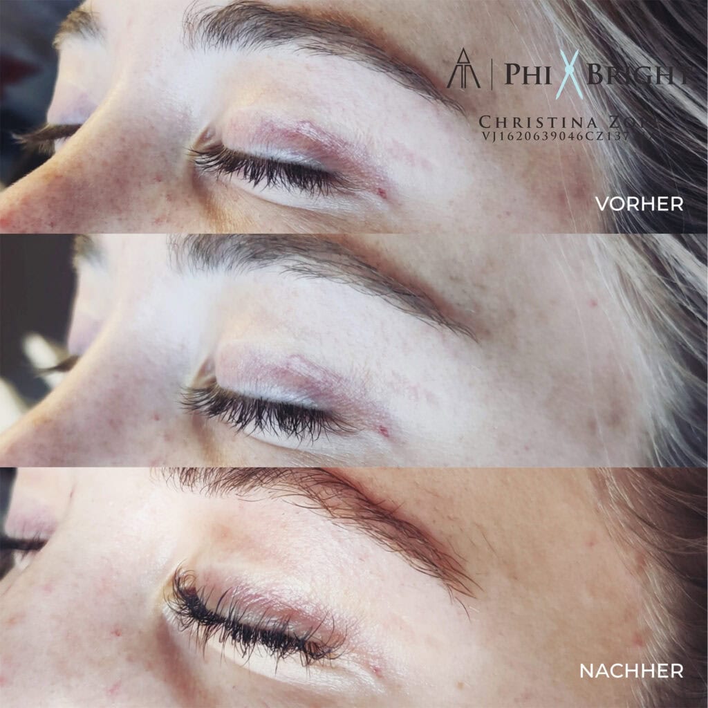 microneedling-vorher-nachher-1