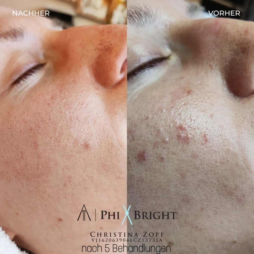 microneedling-vorher-nachher