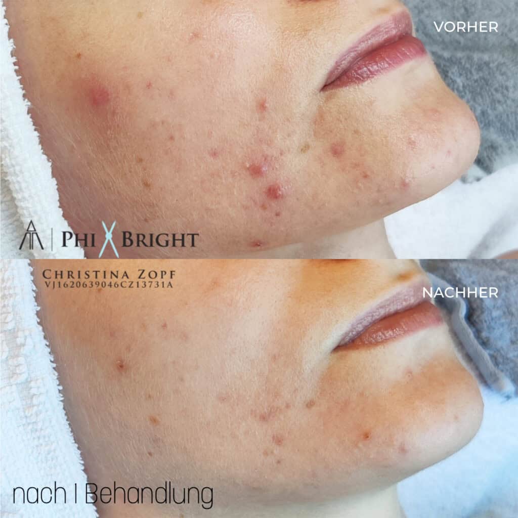 microneedling-vorher-nachher-2
