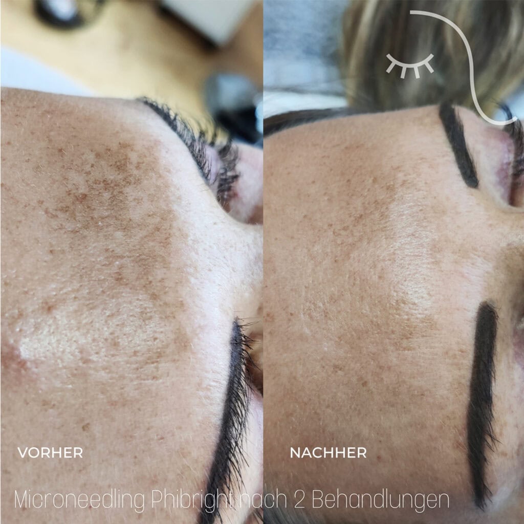 microneedling-vorher-nachher-3