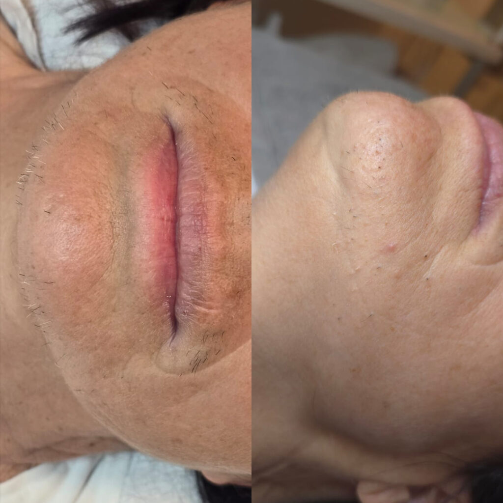 epilfree-vorher-nachher-1