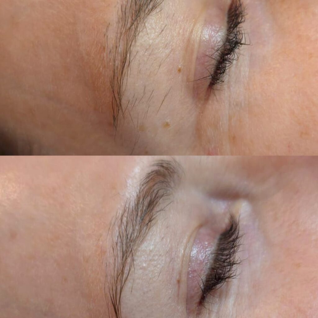 epilfree-vorher-nachher