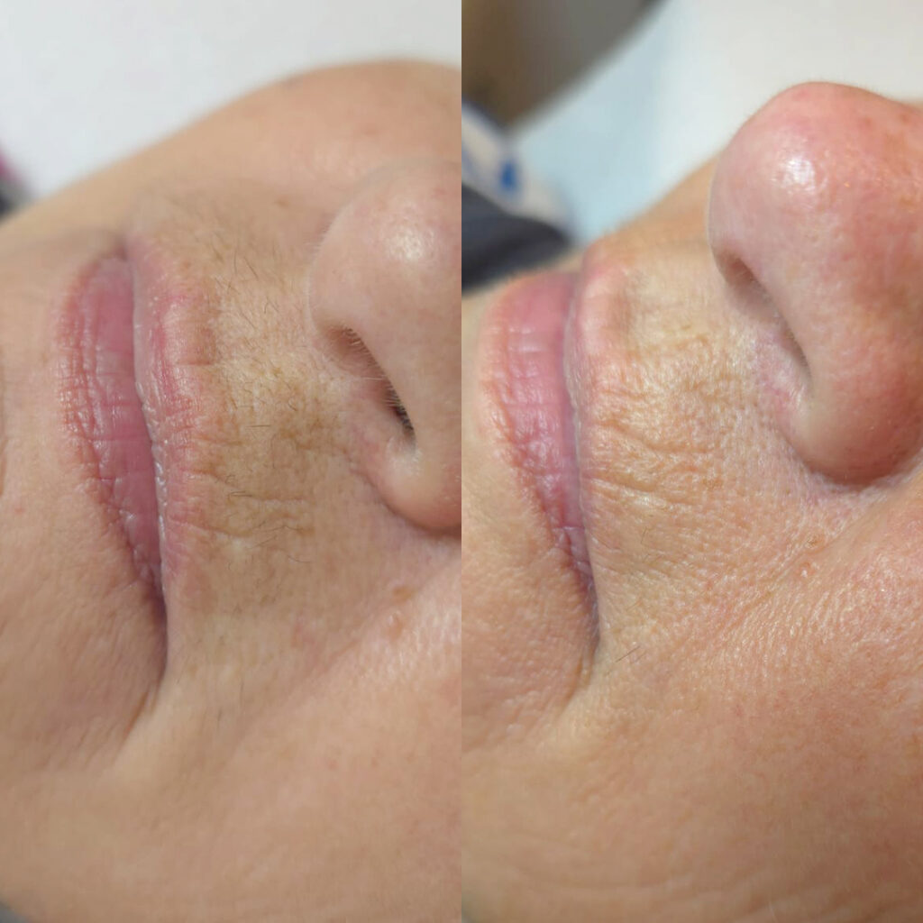 epilfree-vorher-nachher-2