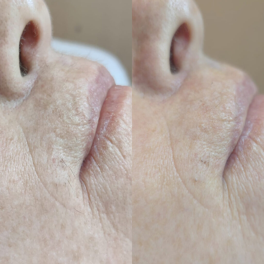 epilfree-vorher-nachher-3