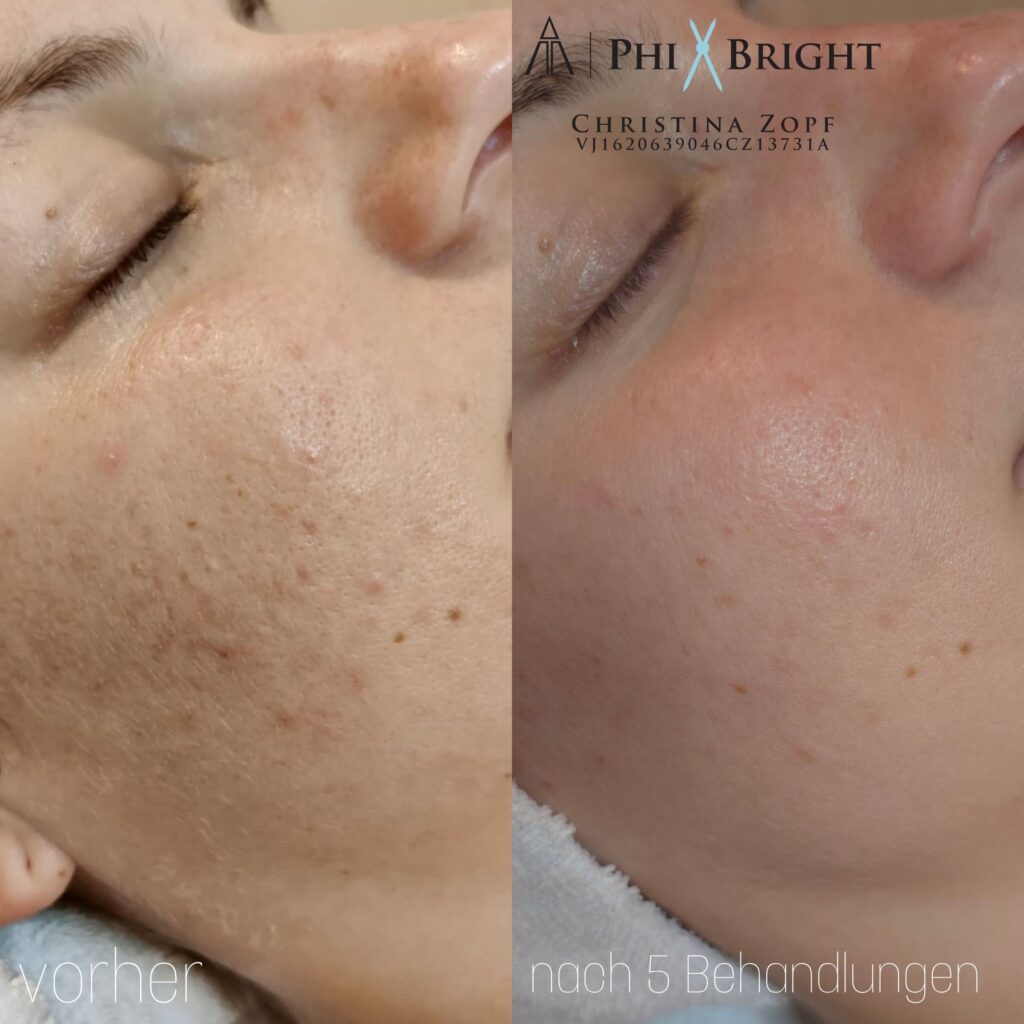 microneedling-vorher-nachher-4
