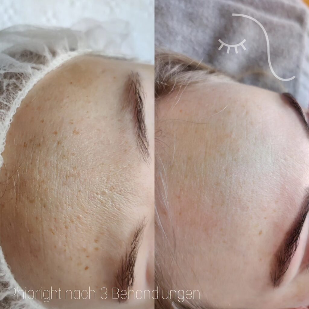 microneedling-vorher-nachher-5