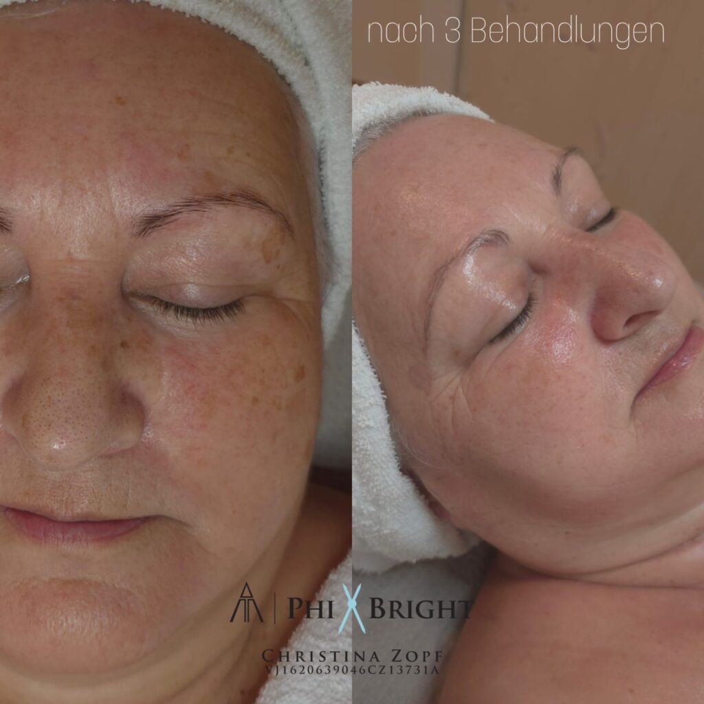 microneedling-vorher-nachher-6